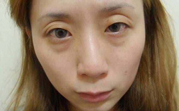 Không phải ai cũng biết, đây là những nguyên nhân khiến bọng mắt ngày một nặng trĩu